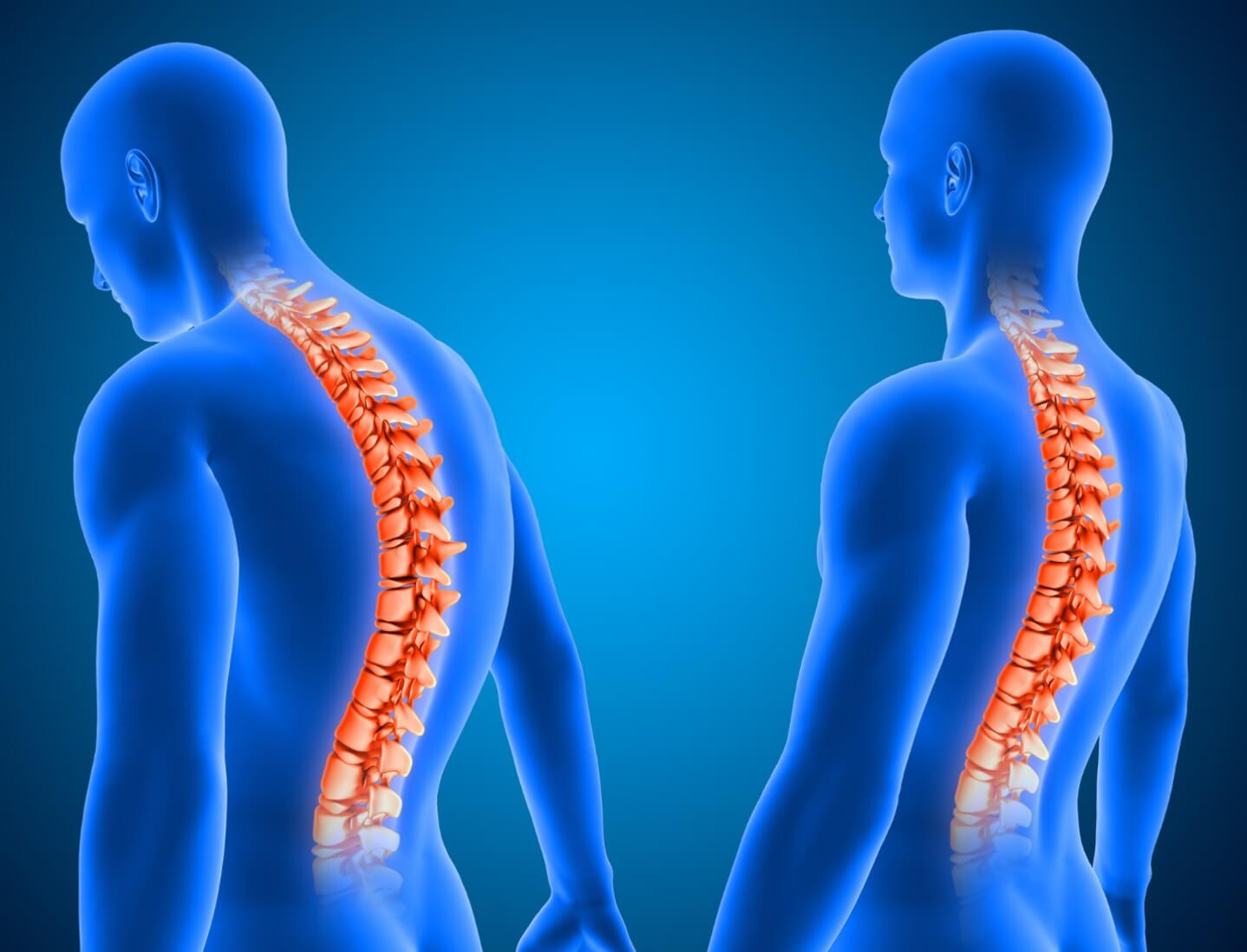 a hanyagtartás, gerinc görbületeinek bemutatása modell segítségével a hyperkyphosis ábrázolásával